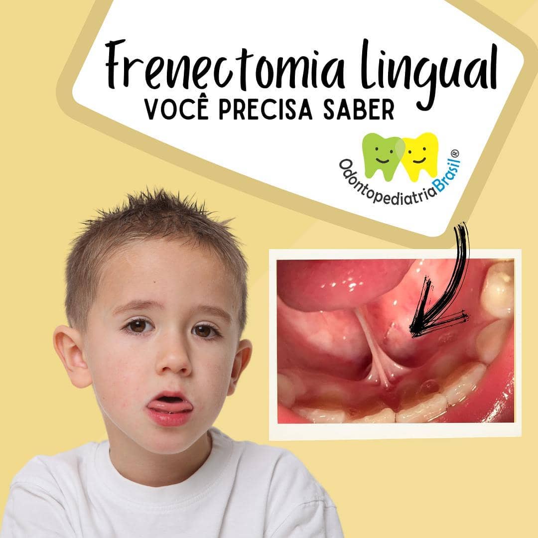 FRENECTOMIA LINGUAL . VOCÊ PRECISA SABER!